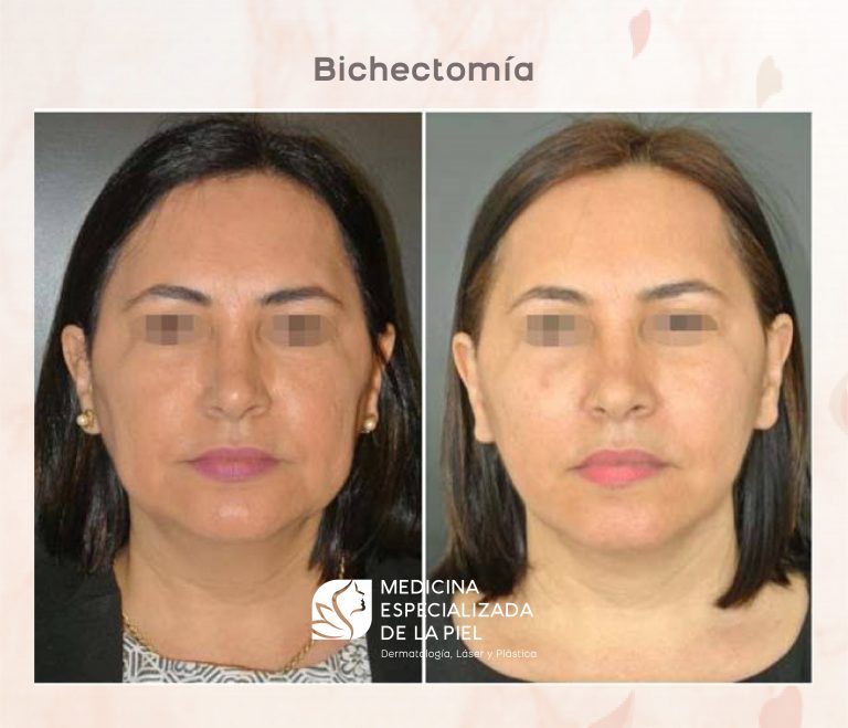 Bichectomía - Medicina Especializada en la Piel Bichectomía Bichectomía
