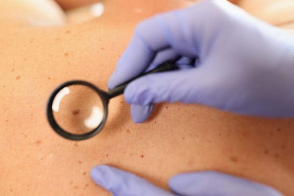 gloved-doctor-dermatologist-with-magnifying-glass-examines-skin-patient-scaled-qkv980wo0dsiq2ztxnc0sllvgh766qvfhy69ztsyao